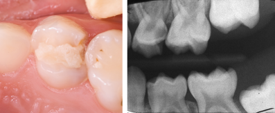 Photograph and radiograph of a symptomatic upper left D