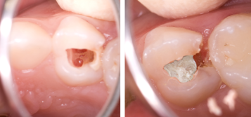 Pulp chamber once haemorrhage arrested and placement of dental repair material in pulp chamber