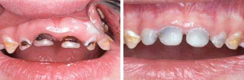 Images showing anterior teeth before and after restoration