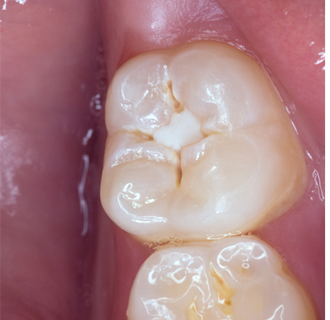 Image showing a tooth with a fissure sealant that requires top up.