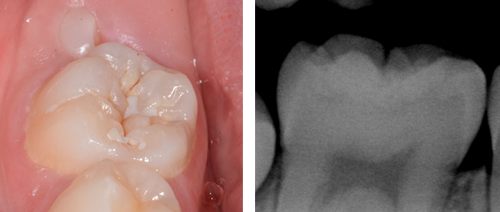 Photograph and radiograph showing initial occlusal caries