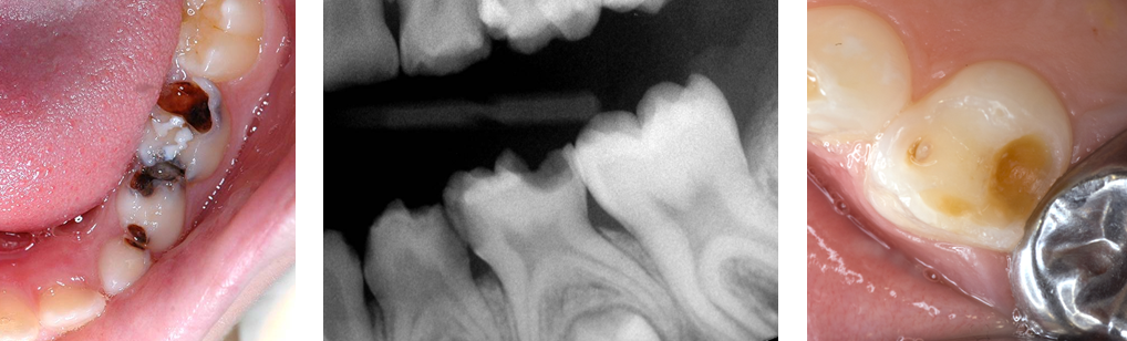 Images of teeth with carious lesions