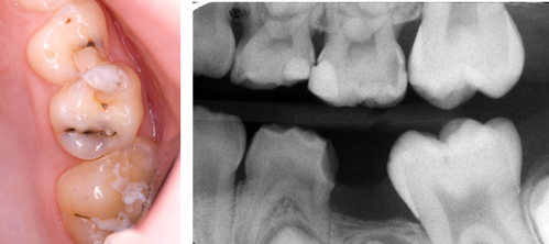 Photograph and radiograph of advanced proximal caries