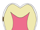 Cartoon of a primary tooth with an inital proximal lesion