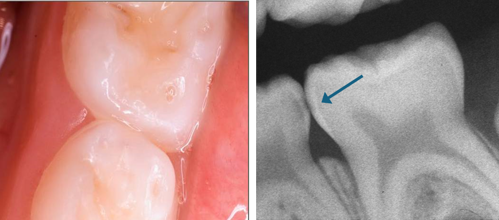 Photograph and radiograph showing initial proximal caries