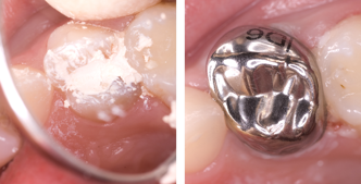 Tooth cavity filled with cement then placement of preformed metal crown