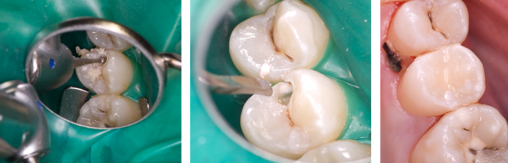 Removal of caries, preparing cavity margins and final restoration