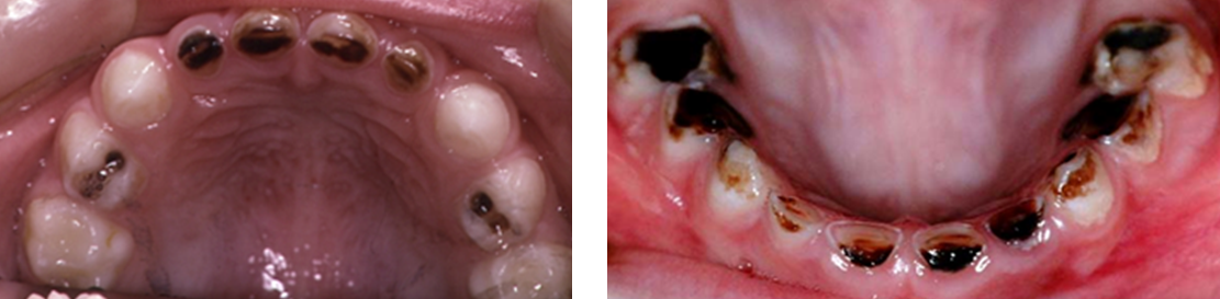 Photographs showing teeth with arrested dentinal caries