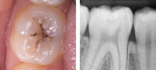 Images showing a molar tooth with moderate occlusal dentinal caries