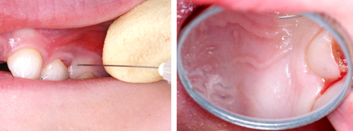 Buccal infiltration injection and blanching of the palatal mucosa