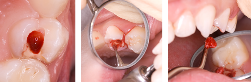 Access cavity and removal of pulp chamber contents