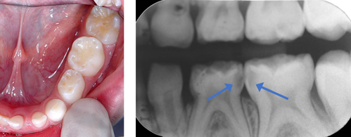 Image and radiograph of a tooth with proximal carious lesion