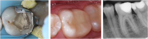 Placement of biomaterial and photograph and radiograph of final restoration