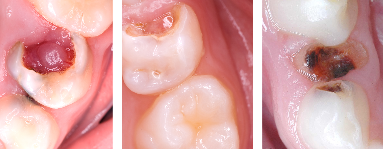 Images of teeth with carous lesions