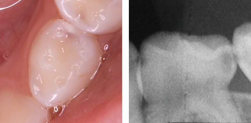 Photograph and radiograph showing advanced proximal caries