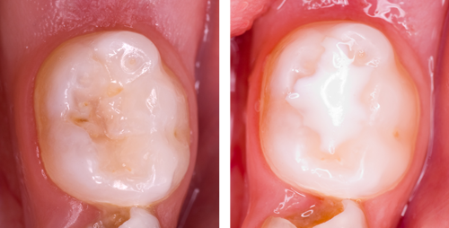 Images showing a molar tooth before and after sealant application