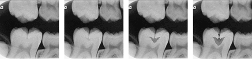 Four radiographs of a tooth showing increasing caries extent