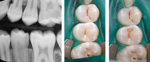 Radiograph of upper premolar and clinical images of carious lesion and cavity preparation