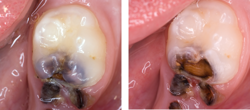 Images showing removal of tooth surface to make carious lesions cleansable