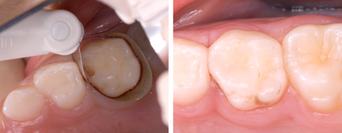 Placement of a matrix band before restoration and the tooth after restoration