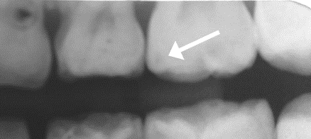 Radiograph of a tooth