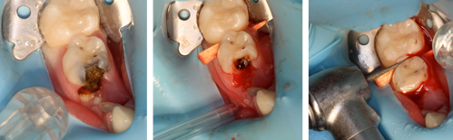 Preparation of a tooth before placement of a preformed metal crown