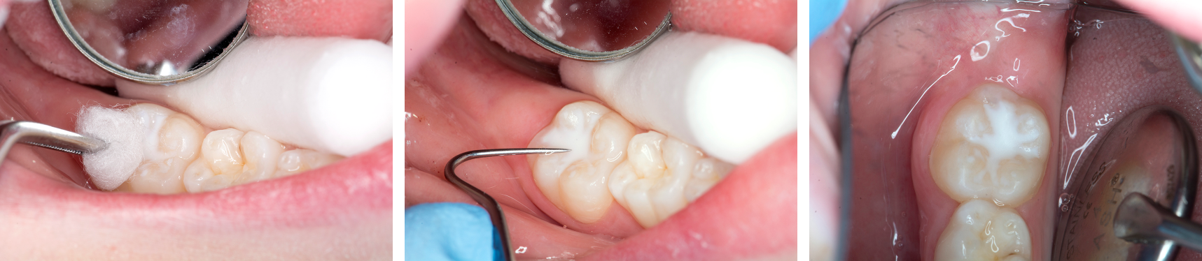 Images showing fissures sealants being checked after application