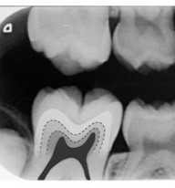 Radiograph of a tooth