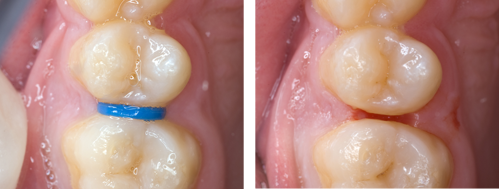 Images show use of a separator to allow visualisation of proximal caries