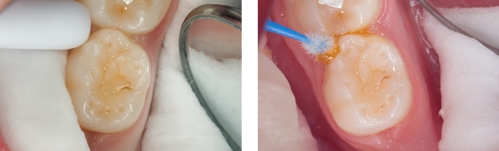 Images showing application of fluoride varnish