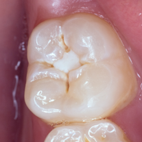 Image shows carious fissures in a permanent molar tooth