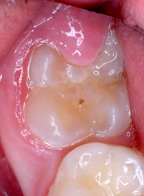 Image showing a partially erupted molar tooth