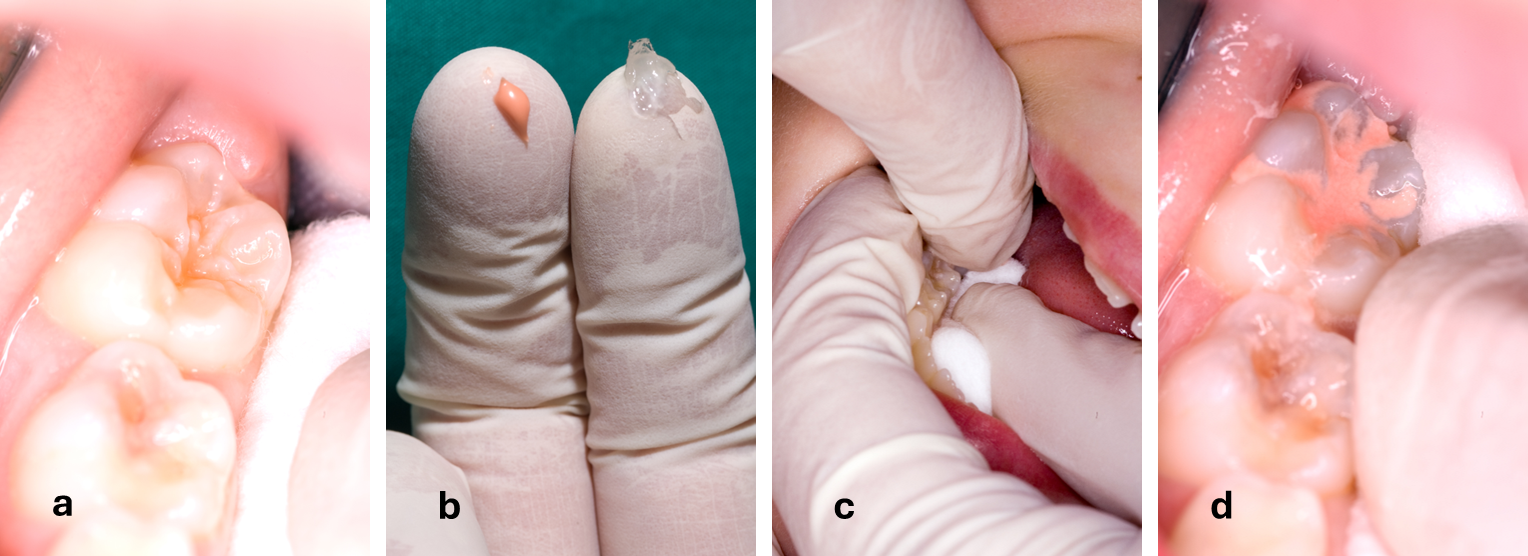 Glass ionomer sealant application