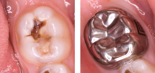 Images showing a tooth with caries before and after application of a preformed metal crown