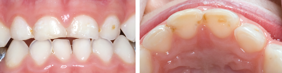 Photographs showing initial anterior caries