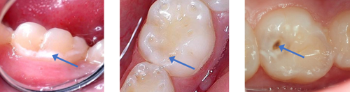 Images of teeth with carious lesions