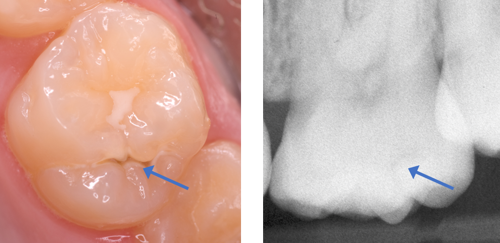 Photograph and radiograph of demineralised enamel next to a fissure