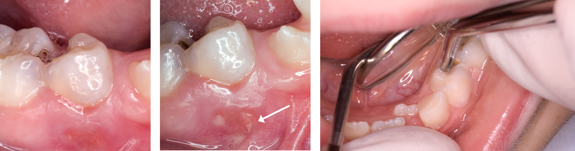 Images showing established dental infection in a tooth