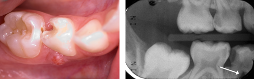 Photograph and radiograph of a tooth with inter-radicular radiolucency