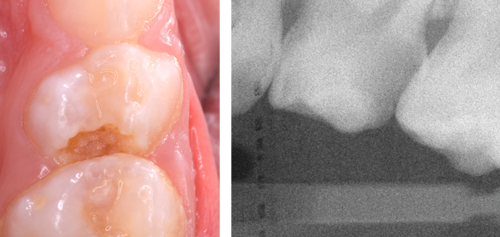 Photograph and radiograph showing a carious tooth with no clear separation between lesion and pulp