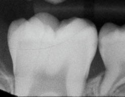 Radiograph showing initial proximal caries