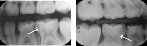 Two radiographs of teeth