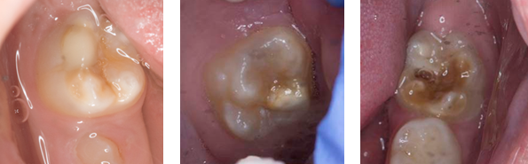 Images showing teeth with Molar Incisor Hypomineralisation