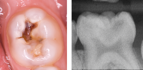 Photograph and radiograph of advanced occlusal caries