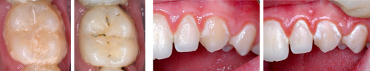 Images showing teeth before and after cleaning