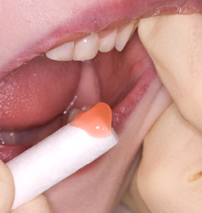 Topical anaesthetic gel being applied to a child's mouth