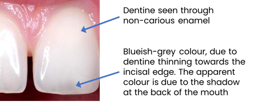 Image of a child's tooth