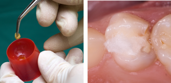 Cotton wool pellet dampened with ferric sulphate and pellet placed in pulp chamber