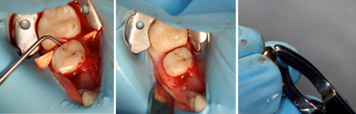 Preparation of a tooth before placement of a preformed metal crown