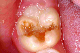 Image shows a first primary molar with advanced caries